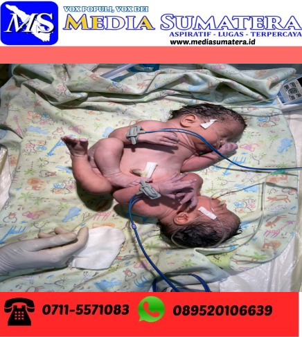 Pemuda Batak Bersatu Ranting Desa Cinta Damai Beri Tali Asih Kepada Bayi Kembar Siam