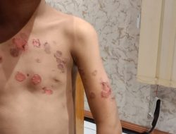Dilarang Berjualan, Karyawan Warkop Sabena II Siram Air Panas Anak 10 Tahun