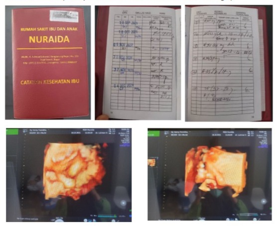 KRONOLOGI TERJADINYA DUGAAN MALAPRAKTEK VANNY FRANSIKA DI RS NURAIDA BOGOR
