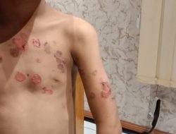 Dilarang Berjualan, Karyawan Warkop Sabena II Siram Air Panas Anak 10 Tahun
