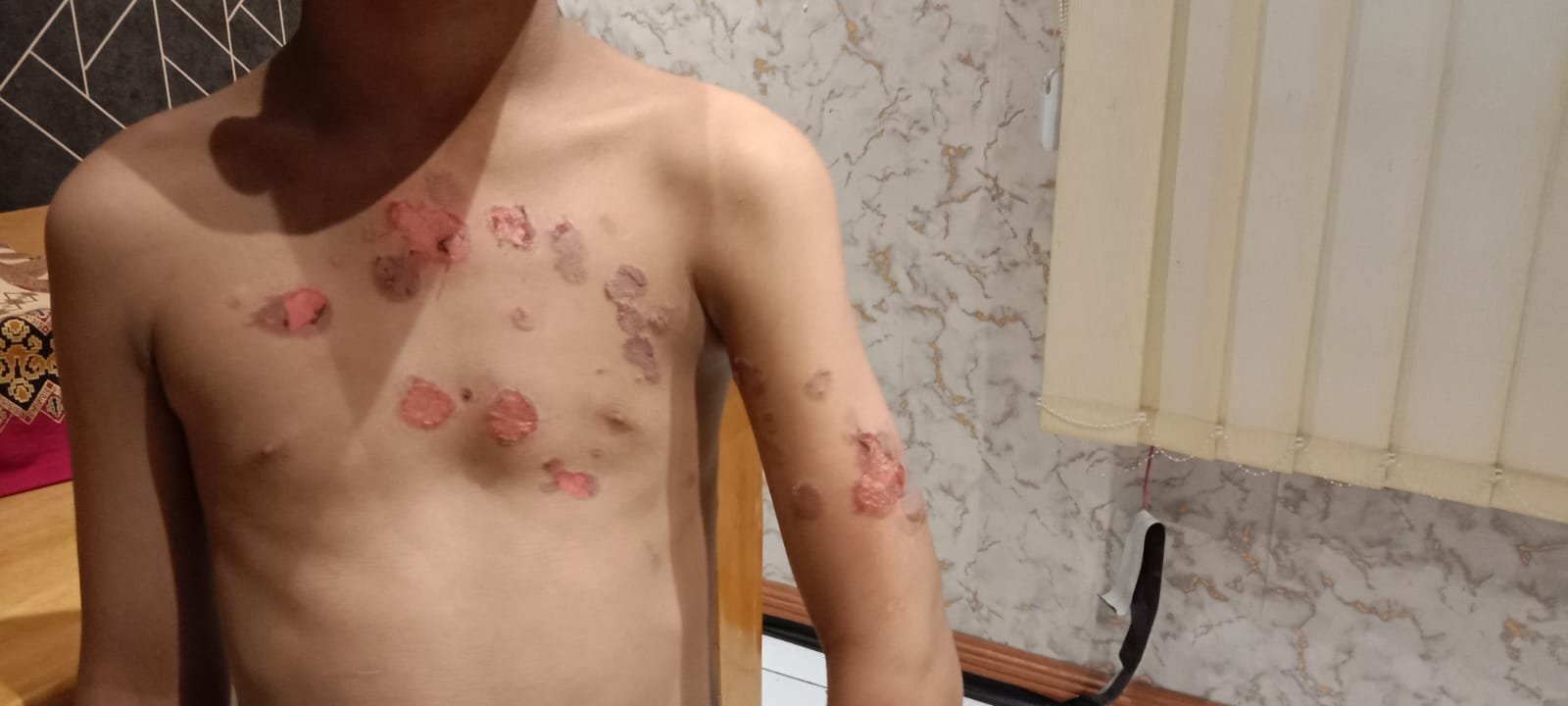 Dilarang Berjualan, Karyawan Warkop Sabena II Siram Air Panas Anak 10 Tahun Dilarang Berjualan, Karyawan Warkop Sabena II Siram Air Panas Anak 10 Tahun