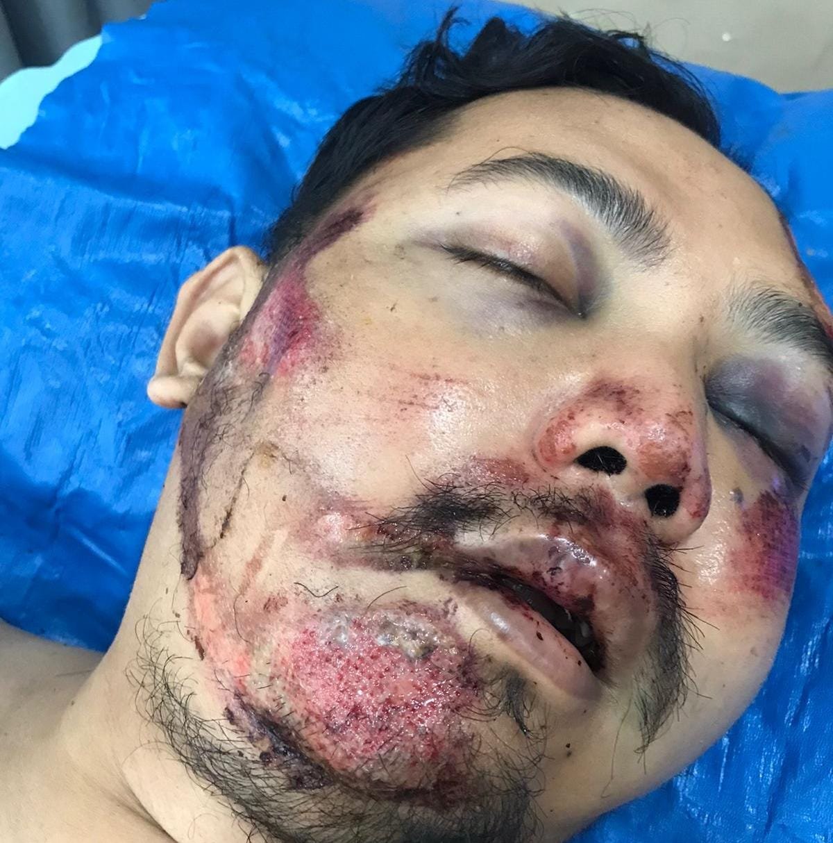 Setengah Badan Patah dan Belum Bisa bergerak, Janji Diingkari dan Seorang Ayah di Medan Berjuang Sendirian